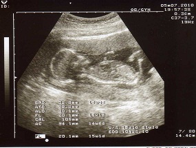 Amelia's Profile at 15 Weeks